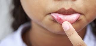 آفت های دهانی در بین زنان شایع تر است