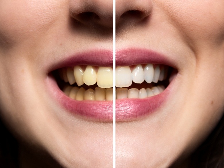 عوامل تغییر رنگ دندان