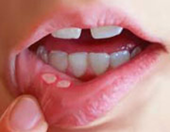يک دندانپزشک اعلام کرد: استرس و مصرف ادويه از عوامل بروز آفت هاي دهاني