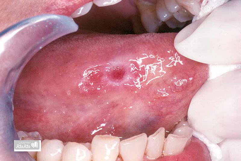 سرطان های دهان ، جزو 10 سرطان شایع بدن