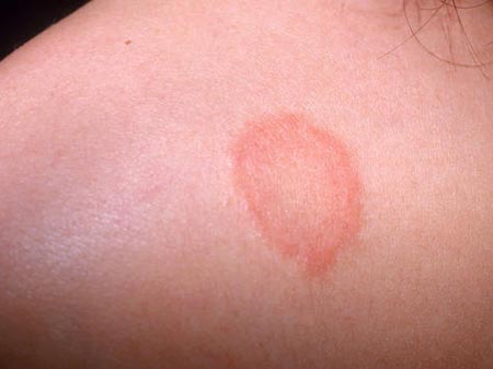 بیماری قارچی، شايع ترين بيماري پوستي در فصل تابستان
