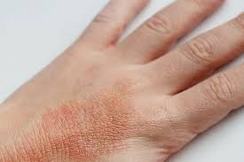 استفاده از صابون های حاوی گلیسیرین برای پیشگیری از اگزما و خشکی پوست