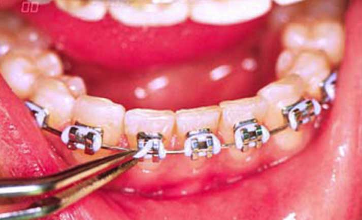 پیشگیری از پوسیدگی دندان ها مهم ترین اصل در ارتودنسی