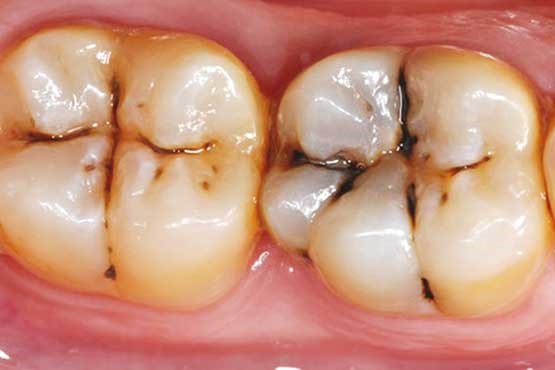 افزایش خطر ابتلا به سرطان های دستگاه گوارش فوقانی با پوسیدگی های دندانی